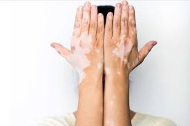 Editorial image for: FDA approval of first topical repigmentation drug for vitiligo