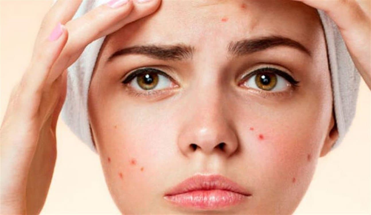Editorial image for: Popping pimples in the facial "Triangle of Death" poses life-threatening risks