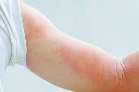 Editorial image for: Urticaria (hives): causes, acute vs. chronic types, and treatment