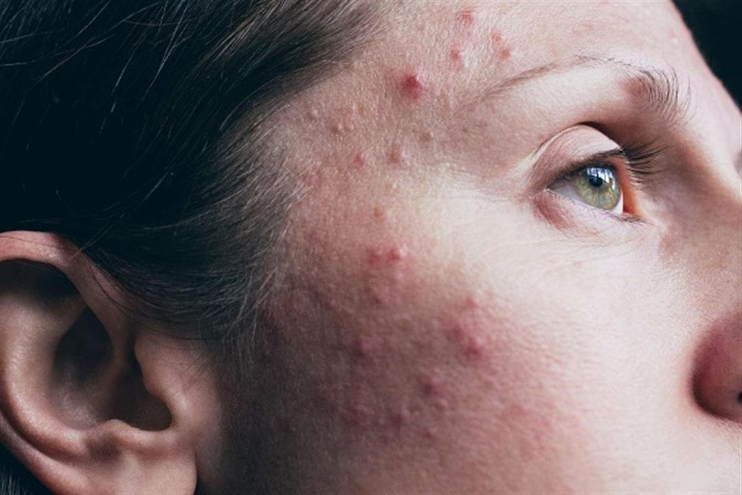 Editorial image for: How to treat acne in 4 steps (Video)