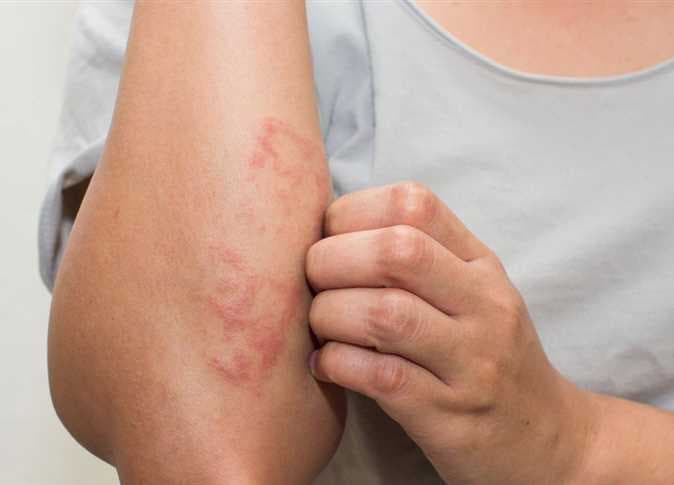 صورة توضيحية عن الأمراض الجلدية