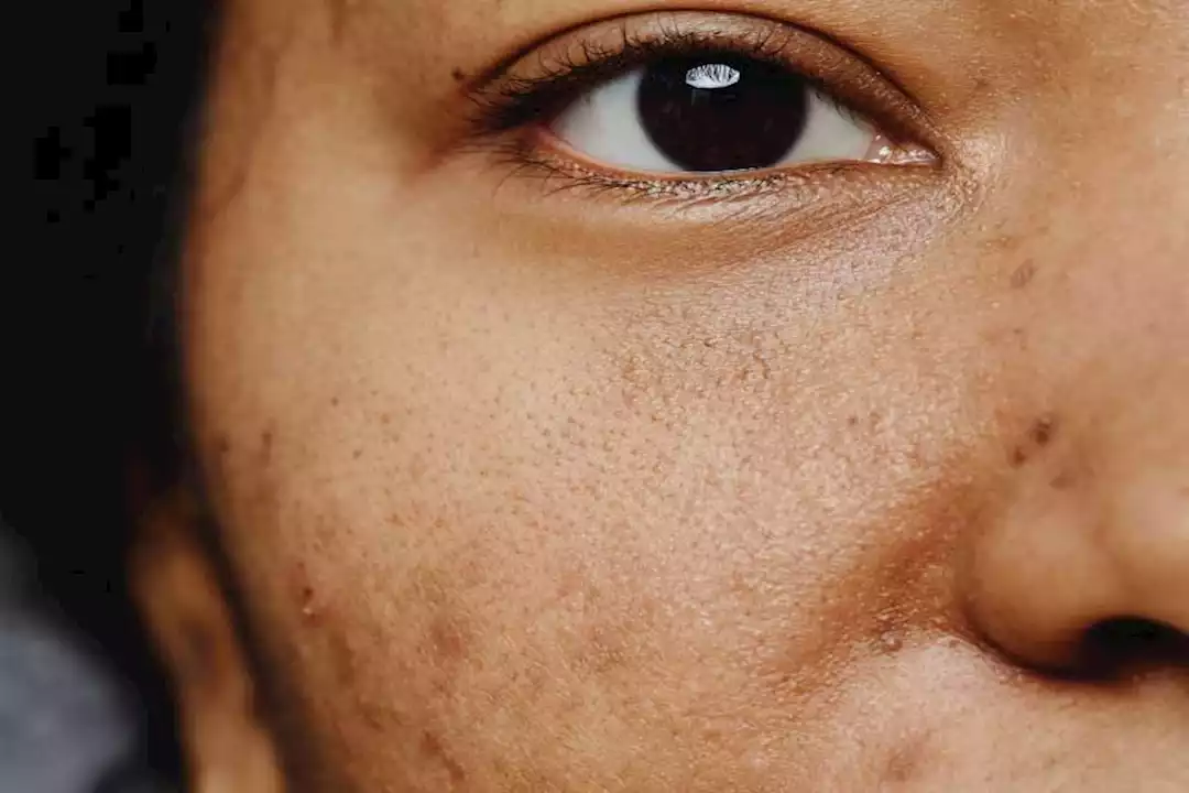 Editorial image for: Multiple causes of skin pigmentation and how to treat them