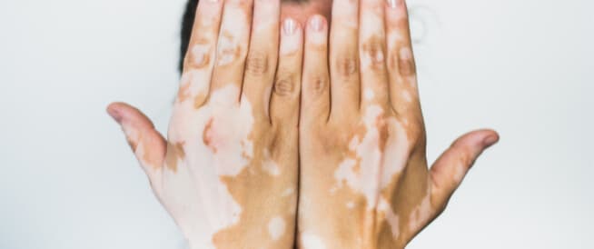 Editorial image for: New gene therapy for vitiligo (Northwestern University HSP70i study)