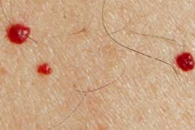 Editorial image for: Red spots like sesame seeds: are they a sign of skin cancer?
