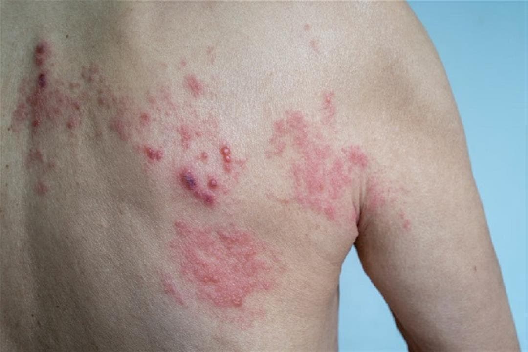 صورة توضيحية عن الأمراض الجلدية