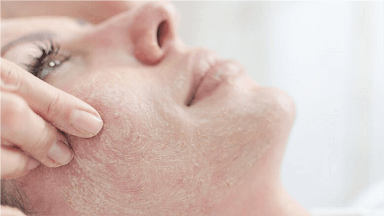Repeated exfoliation may harm the skin barrier